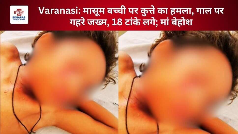 Varanasi: मासूम बच्ची पर कुत्ते का हमला, गाल पर गहरे जख्म, 18 टांके लगे; मां बेहोश