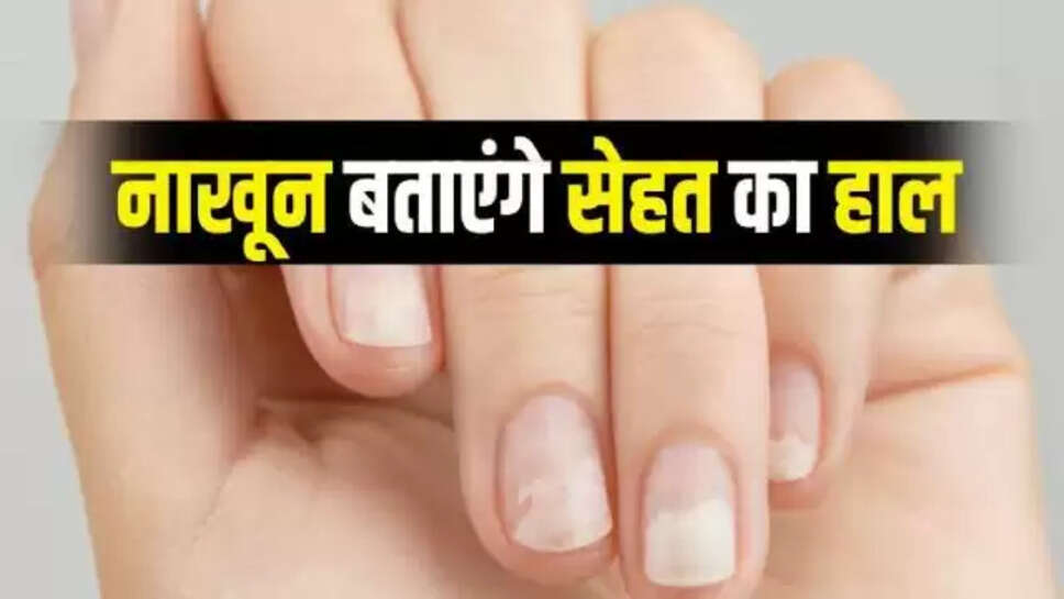 White Spots On Nails