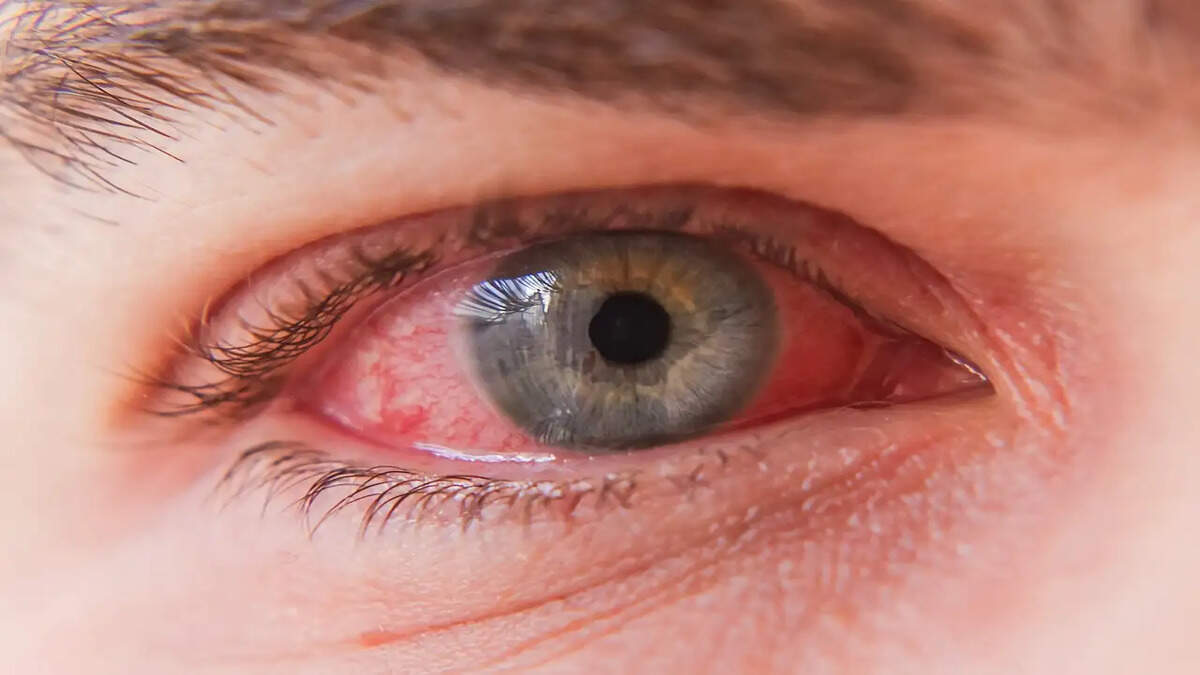 Pink Eyes