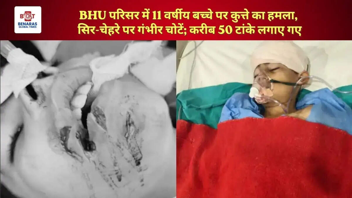 BHU परिसर में 11 वर्षीय बच्चे पर कुत्ते का हमला, सिर-चेहरे पर गंभीर चोटें; करीब 50 टांके लगाए गए