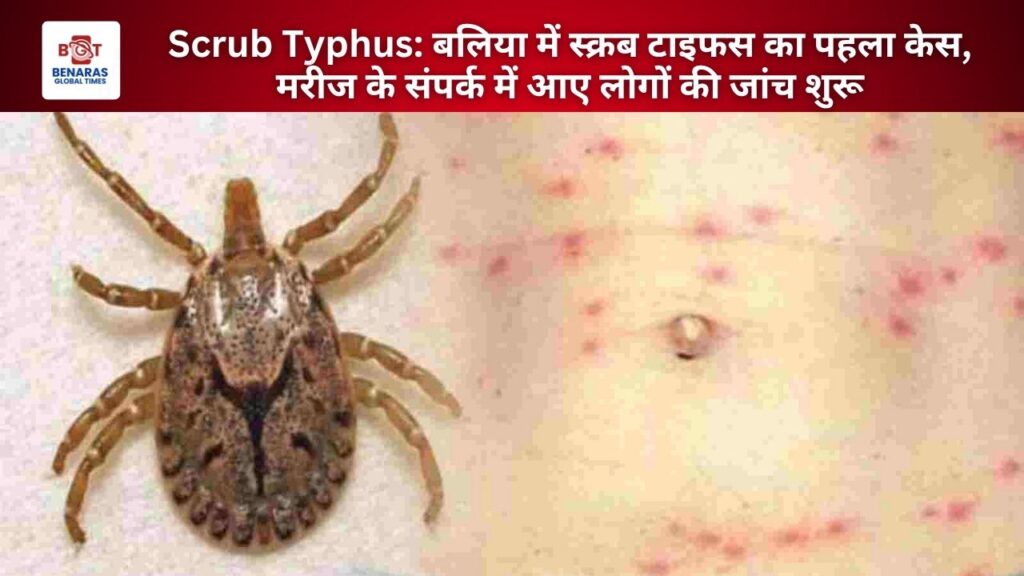Scrub Typhus: बलिया में स्क्रब टाइफस का पहला केस, मरीज के संपर्क में आए लोगों की जांच शुरू Scrub Typhus: बलिया में स्क्रब टाइफस का पहला केस, मरीज के संपर्क में आए लोगों की जांच शुरू Scrub Typhus: बलिया में स्क्रब टाइफस का पहला केस, मरीज के संपर्क में आए लोगों की जांच शुरू