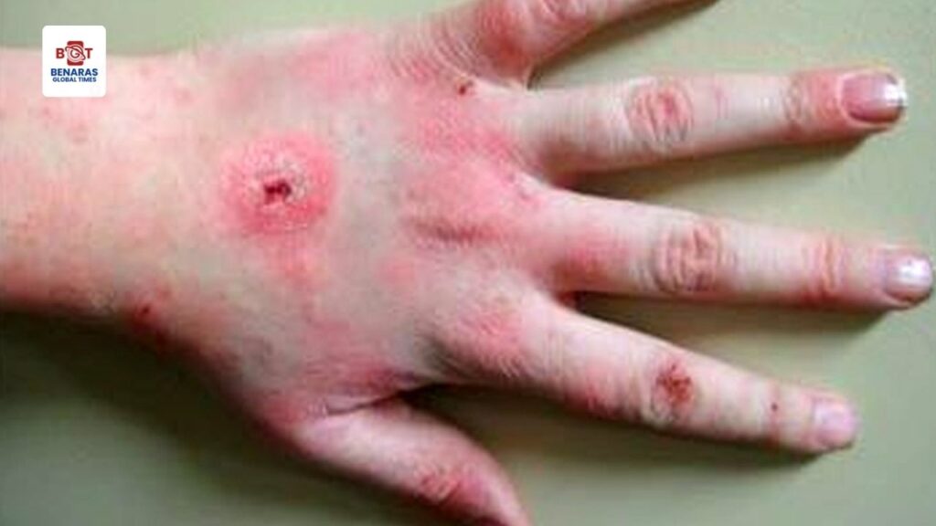 Scrub Typhus: बलिया में स्क्रब टाइफस का पहला केस, मरीज के संपर्क में आए लोगों की जांच शुरू Scrub Typhus: बलिया में स्क्रब टाइफस का पहला केस, मरीज के संपर्क में आए लोगों की जांच शुरू Scrub Typhus: बलिया में स्क्रब टाइफस का पहला केस, मरीज के संपर्क में आए लोगों की जांच शुरू